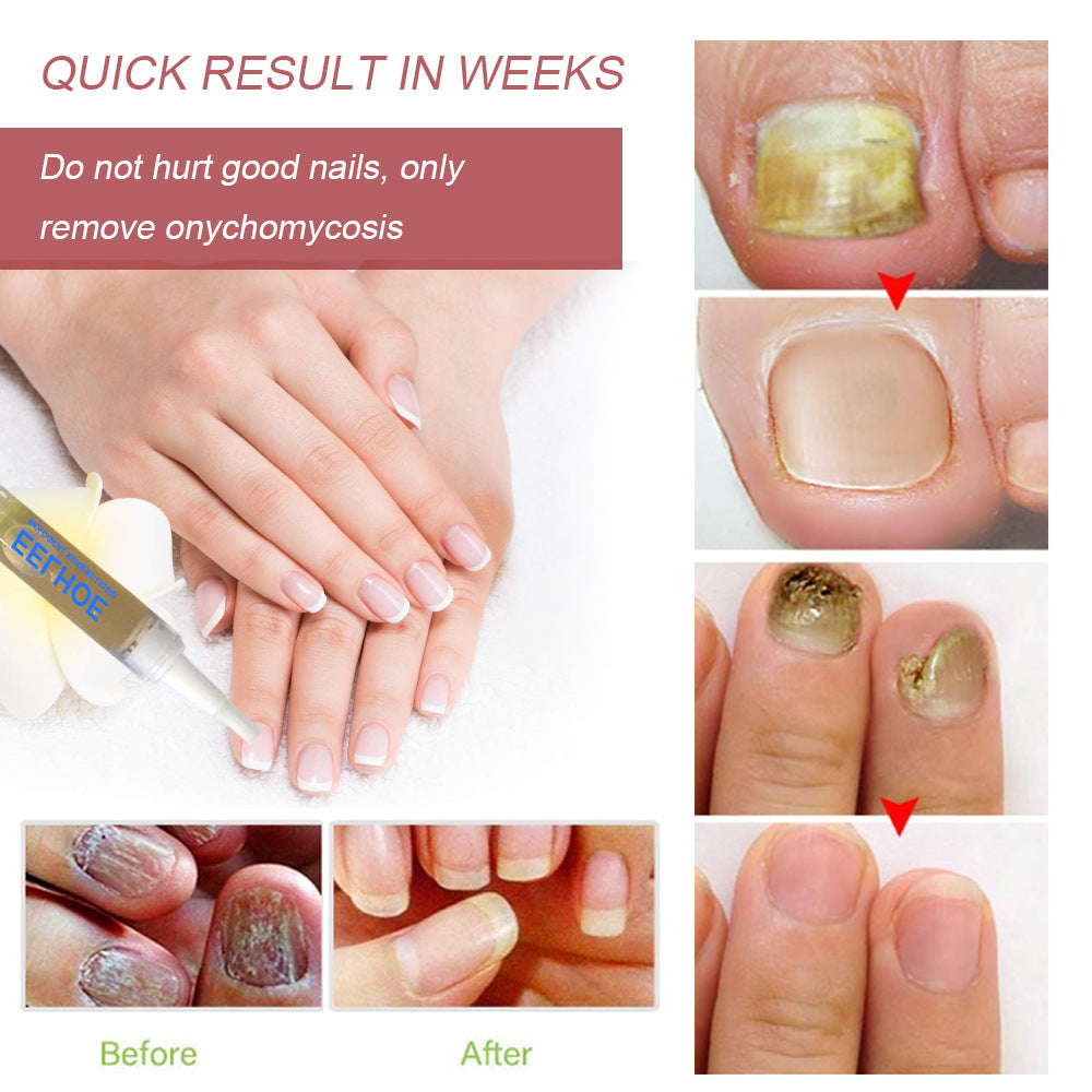 EELHOE Gray Nail Treatment and Repair Liquid